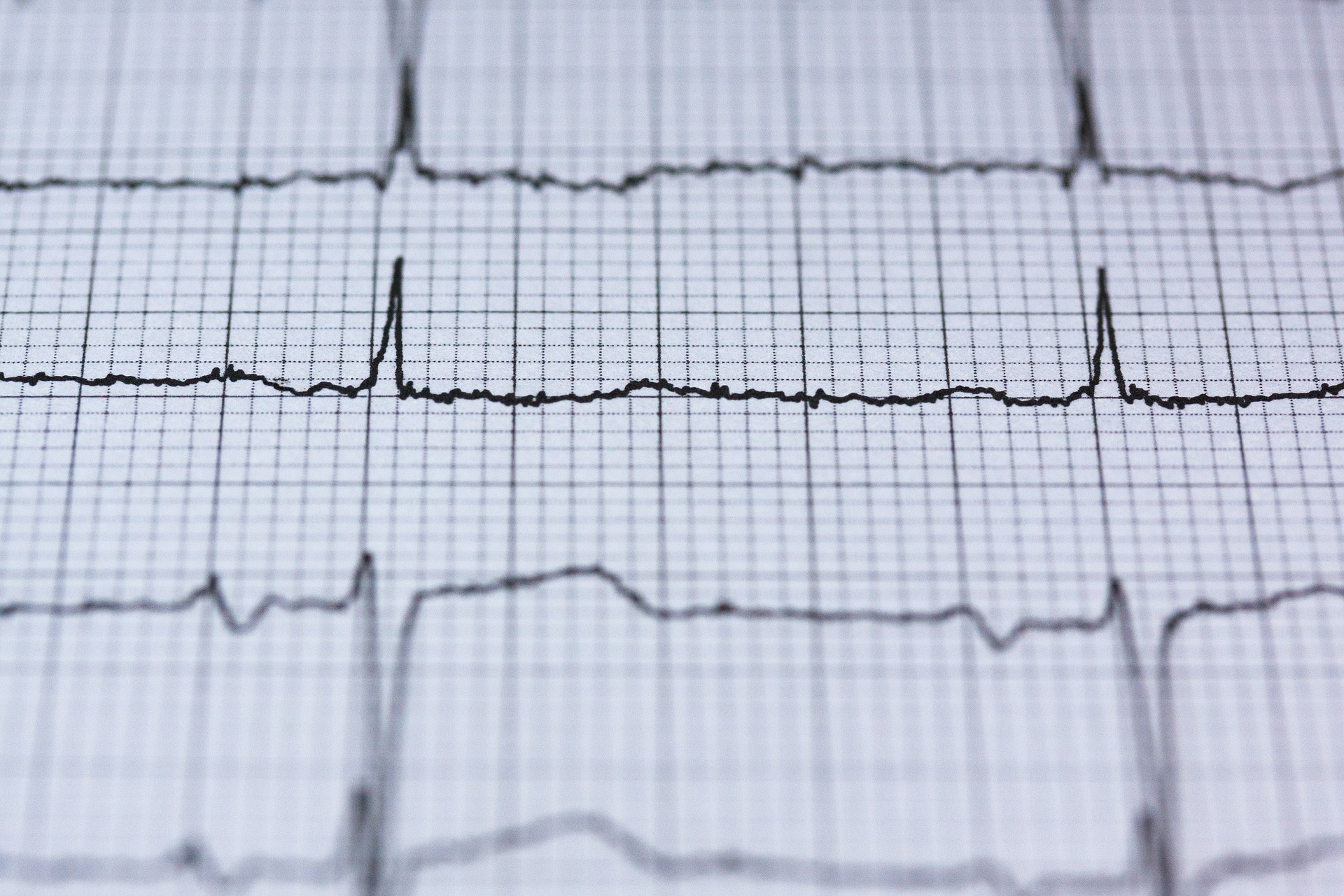 Everything You Need To Know About Kardia ECG