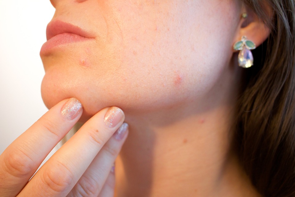 Acne Scar Treatment Options